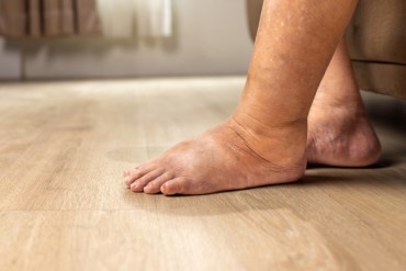 Gambar artikel Kenapa Kaki Bisa Bengkak? Mengenal Edema dari Perspektif Jantung